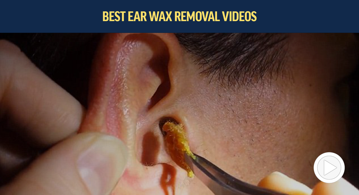 Best Ear Wax Removal Videos Axel Glade