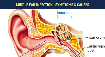 Ear Infection (Middle Ear) – Symptoms and Causes